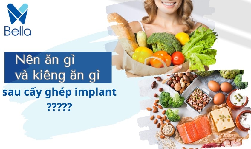 trong rang implant an gi va kieng an gi de nhanh hoi phuc