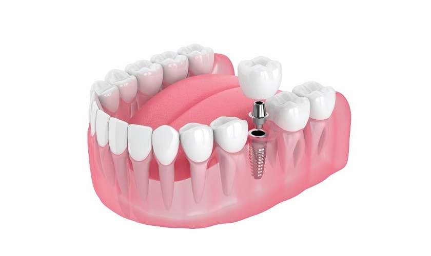 Trồng răng implant số 6 là phương pháp tốt nhất hiện nay