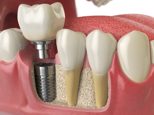 trồng răng số 7 bằng implant là phương pháp hiệu quả nhất hiện nay