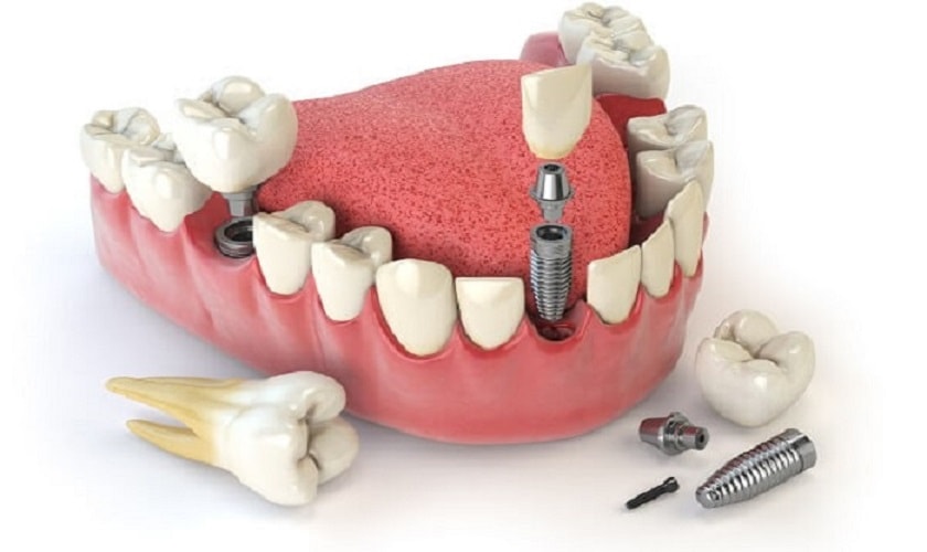 Nhổ răng bao lâu thì trồng implant tức thì