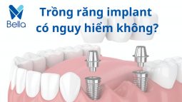 Trồng răng implant có nguy hiểm không? Sự thật ra sao?