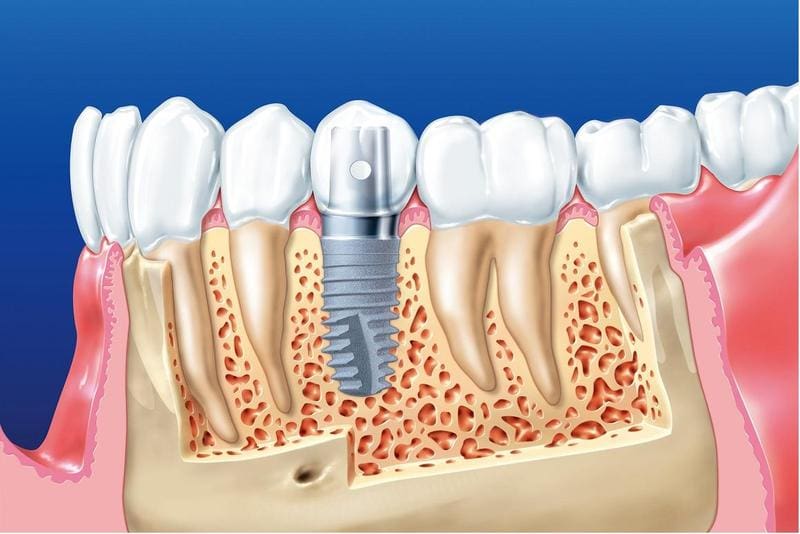 Trồng răng implant có bền không còn phụ thuộc vào khả năng tích hợp với xương