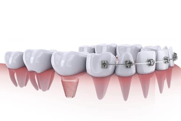 Trồng răng Implant có niềng được không còn tùy thuộc vào vị trí cấy ghép implant