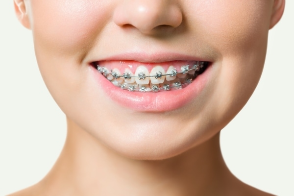 Trồng răng Implant có niềng được không? Cần lưu ý gì?