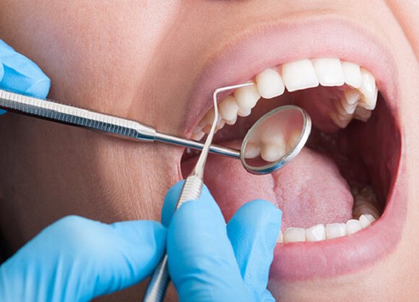 Cạo vôi răng có làm trắng răng không?