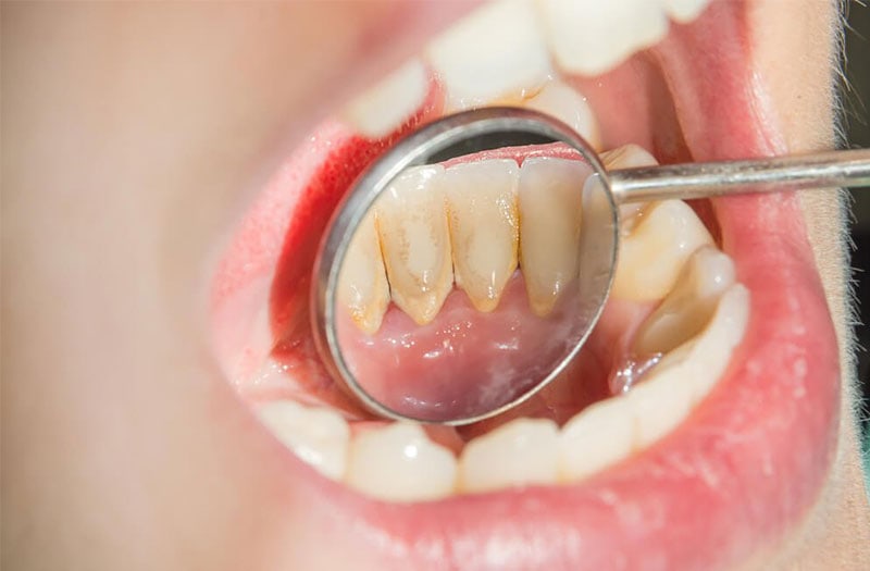 Lấy cao răng có tốt không, có ảnh hưởng gì không?