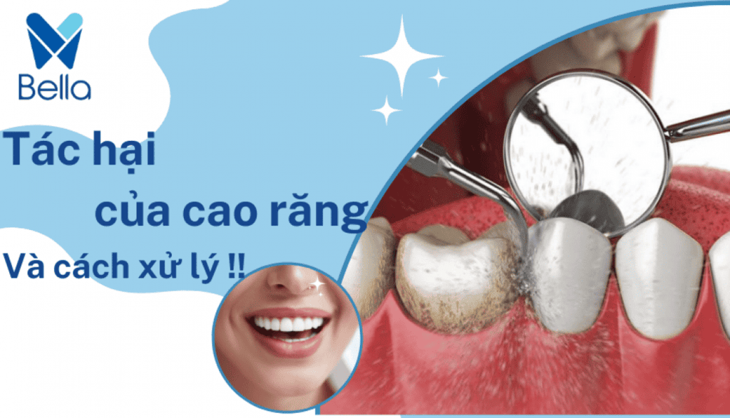 Tác hại của cao răng và cách xử lý