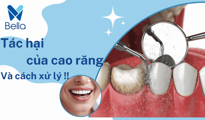 Tác hại của cao răng và cách xử lý