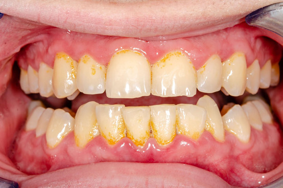 Lấy cao răng có lâu không? Bao lâu thì lấy cao răng 1 lần