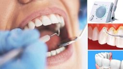 Gợi ý 7 nha khoa cạo vôi răng an toàn tại TPHCM