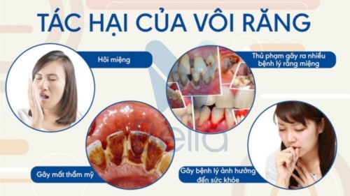 Tác hại của cao răng và cách xử lý vôi răng