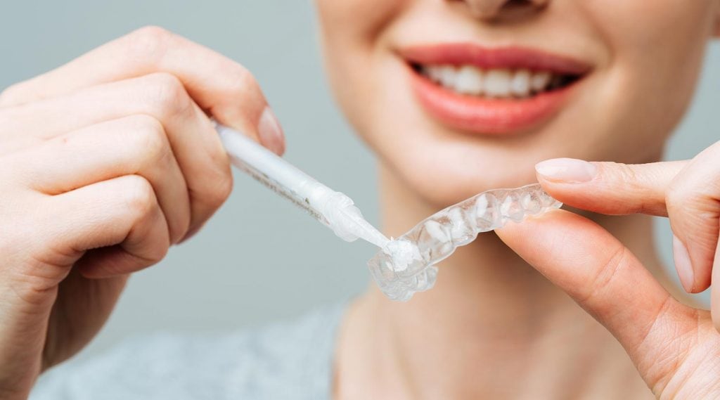 Tẩy trắng răng tại nha khoa bằng máng nhựa