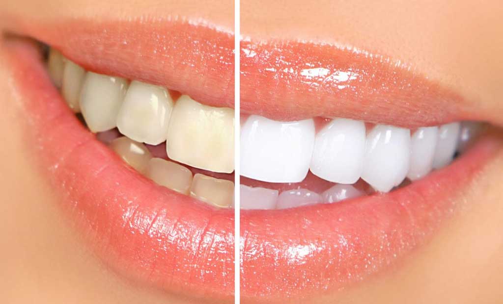 Tẩy trắng răng tại nha khoa có thật sự hiệu quả