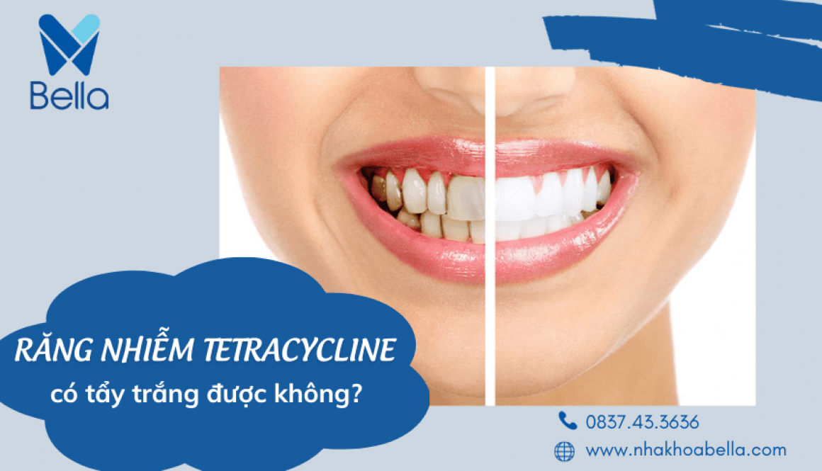 Răng nhiễm tetracycline có tẩy trắng được không 1