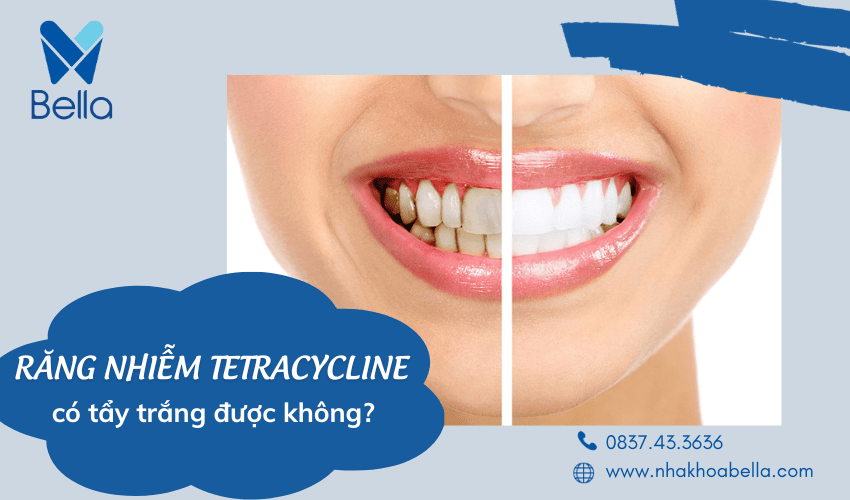 Răng nhiễm tetracycline có tẩy trắng được không 1