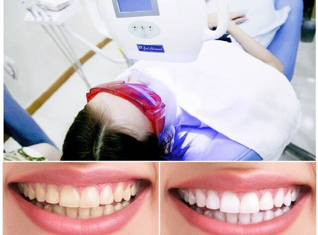 Đèn tẩy trắng răng có thực sự đem lại hiệu quả không?