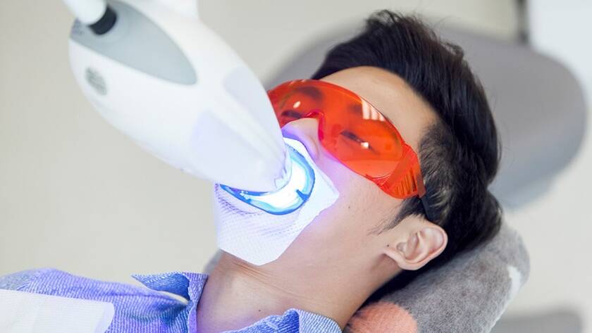 Thắc mắc: Răng sứ có tẩy trắng được không?