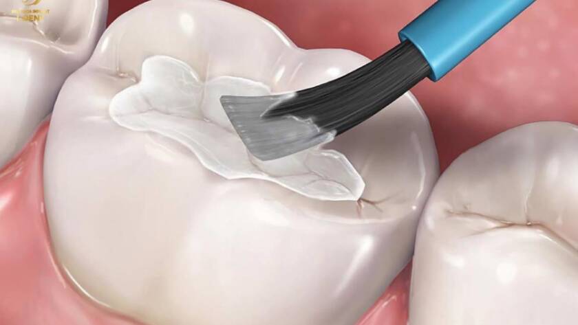 Trám răng có đau không? Hạn chế đau nhức khi trám răng