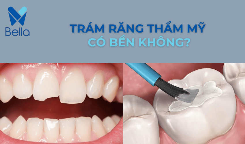 Trám răng có bền không, bao lâu thì nên trám lại?