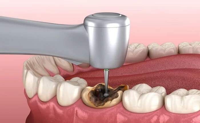 Trám răng có đau không và cách hạn chế đau nhức khi trám răng