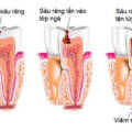 Trám răng có cần lấy tủy không? Ưu và nhược điểm của trám răng lấy tủy