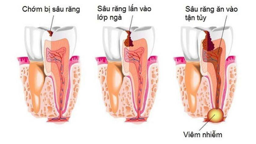 Trám răng có cần lấy tủy không? Ưu và nhược điểm của trám răng lấy tủy