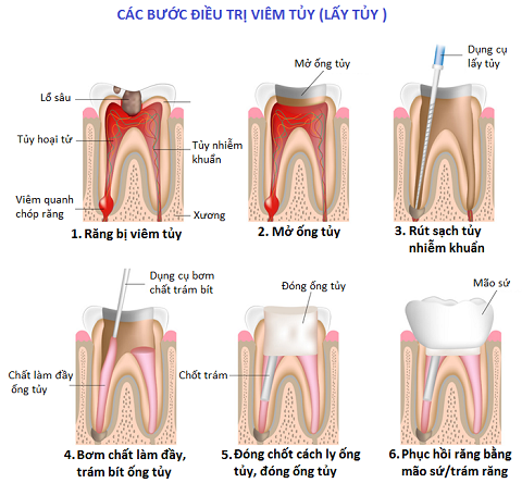Trám răng có cần lấy tủy không - Các bước lấy tủy trám răng không đau tại Nha Khoa Bella