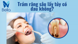 Trám răng lấy tủy có đau không? Công nghệ trám răng lấy tủy không đau