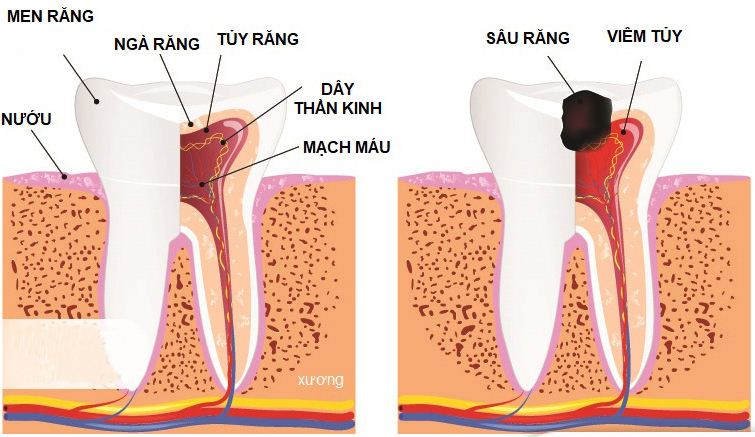 Trám răng lấy tủy có đau không? Các loại viêm tủy
