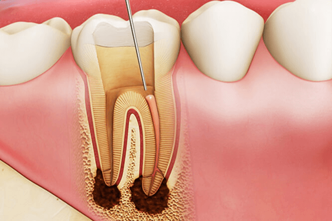 Trám răng lấy tủy có đau không? 